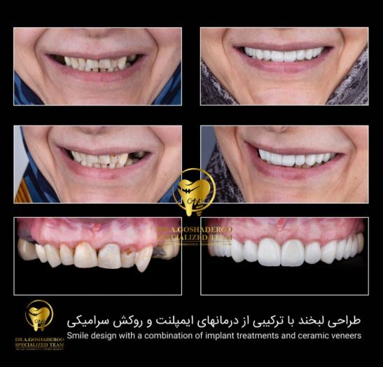 ایمپلنت دیجیتالی